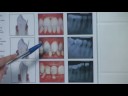 Teeth Whitening : Identifying Moderate Periodontitis Teeth Whitening : Identifying Moderate Periodontitis