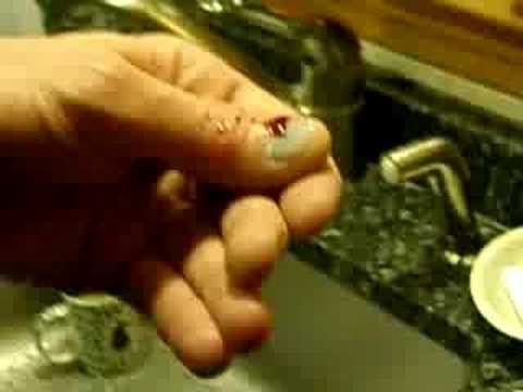 how to drain hematoma