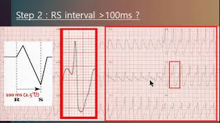 Advanced course - Ventricular tachycardia 속터지는 심전도 - 순천성가롤로병원 이두환