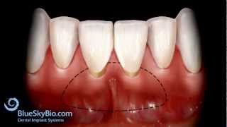 Free Gingival Graft