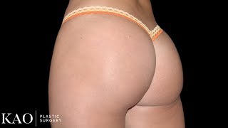 Brazilian Butt Lift