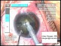 Cataract Surgery Horizontal Chop Technique by Uday Devgan MD Cataract Surgery Horizontal Chop Technique by Uday Devgan MD