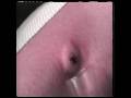 Tick Removal: Blister & Straw and Knot Methods