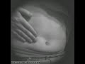bouncing the lumps (slap on stomach)
