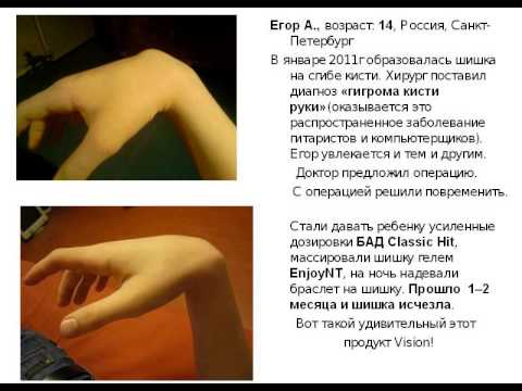 Как удалить гигрому в домашних условиях Как удалить гигрому в домашних условиях