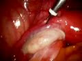 tubal sterilizasyon