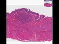 Histopathology Stomach--Tuberculosis Histopathology Stomach--Tuberculosis