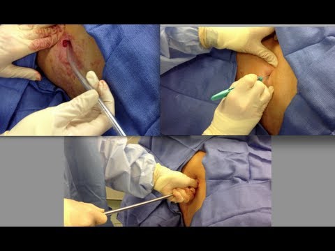 how to drain chest tube