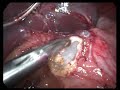 Failure of gastric band (herniation) Failure of gastric band (herniation)