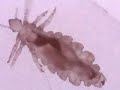 Head Lice