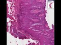 Histopathology Skin--Arsenical keratosis Histopathology Skin--Arsenical keratosis