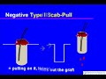 Graft Anchoring in Hair Transplantation Surgery