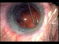 J-cannula use for cortical clean up replaces Irrigation-Aspiration. J-Cannula is much faster and safer as it avoids capsular rupture during I/A.