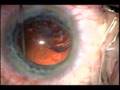 J-cannula use for cortical clean up replaces Irrigation-Aspi