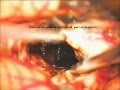 CAVERNOUS ANGIOMA BRAIN STEM-microsurgery-dr suresh dugani/S.D.M.medical college DHARWAR/INDIA