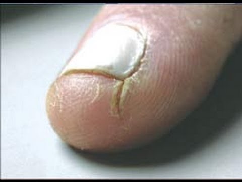 how to treat sliced finger tip