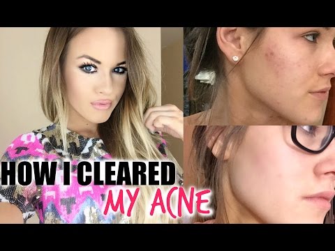 How I Cleared My Acne