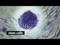 Living with Lymphoma Living with Lymphoma