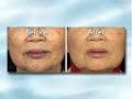 Fraxel Laser - Piedmont Plastic Surgery & Dermatology, NC Fraxel Laser - Piedmont Plastic Surgery & Dermatology, NC
