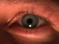 voluntary pupil dilation voluntary pupil dilation