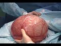 Pcte con Tumor de ovario izquierdo de 22x16cm que reporto el patologo cistoadenoma de ovario iquierdo.Ademas tenia Litiasis vesicular (calculo en la vesicula biliar.Se practico Extirpacion del ovario izquierdo (Ooforectomia)mas colecistectomia
