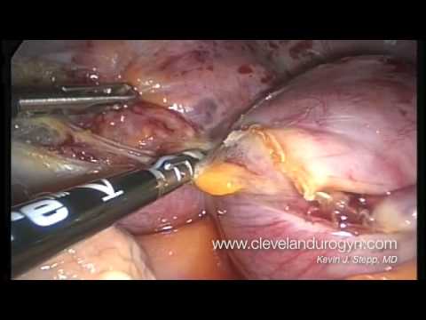 ovaries - A narrated, full-length total laparoscopic hysterectomy and removal of both ovaries for fibroids and pelvic pain. A Ligasure device is used to seal the vesse...