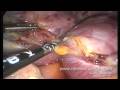 Laparoscopic Excision Of Uterus And Ovaries - Part 1 Of 4