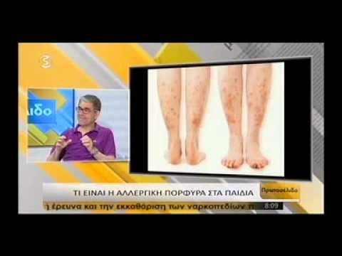 Αλλεργική πορφύρα