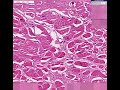 Histopathology Heart --Amyloidosis