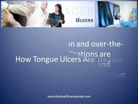 how to cure tongue sores