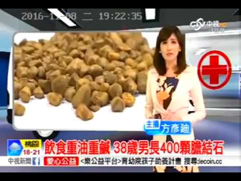 105 11 08中視:飲食重油重鹹 38歲男長400顆膽結石