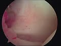 shoulder anatomy glenohumeral ligament