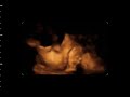 My Daughter - 4D Ultrasound Scan My Daughter - 4D Ultrasound Scan