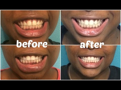 how to whiten teeth in a week