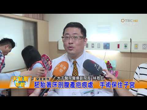108 05 02大苗栗新聞:胚胎著床剖腹產疤痕處 手術保住子宮
