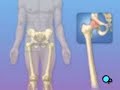 hip-replacement-nana.html