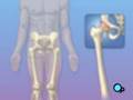 PreOp® Orthopedic: Hip Replacement Patient Education