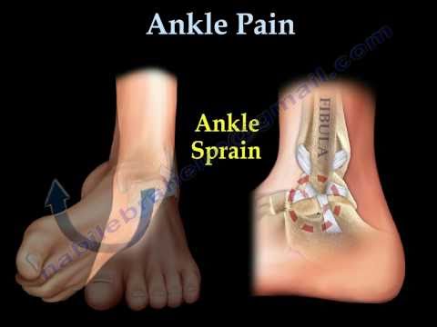 how to relieve sprained ankle pain