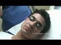 Laser Acne Scar Removal with Our Skin Resurfacing Treatment