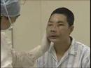 Human face transplantation