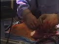 open-heart-surgery-by-mark-lowry-comedy.html