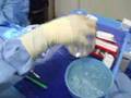 Breast Augmentation (Silicone) & Chin Revision Surgery