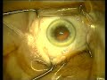 Cataract surgery