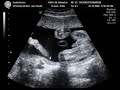 Our foetus at 25 weeks