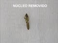 ENDODONTIA – REMOÇÃO DE NÚCLEO COM AUXÍLIO DE ULTRASSOM