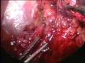 videos de Splenic Vessels Operation by LOTUS Torsional UltraSound