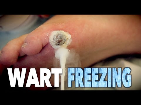 GIANT WART FREEZING (with liquid nitrogen) | Dr. Paul