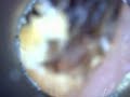 Ear Wax Removal