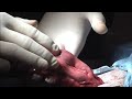 Pyometra