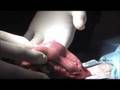 Pyometra